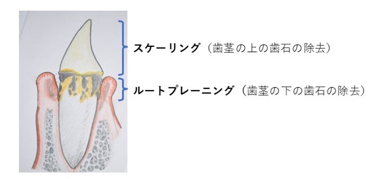 空け―リング（歯茎の上の歯石の除去）　ルートプレーニング（歯茎の下の歯石の除去）